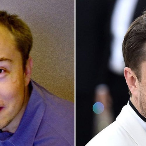 Elon Musk Hair Transplant: From Tech Visionary to Hair Icon