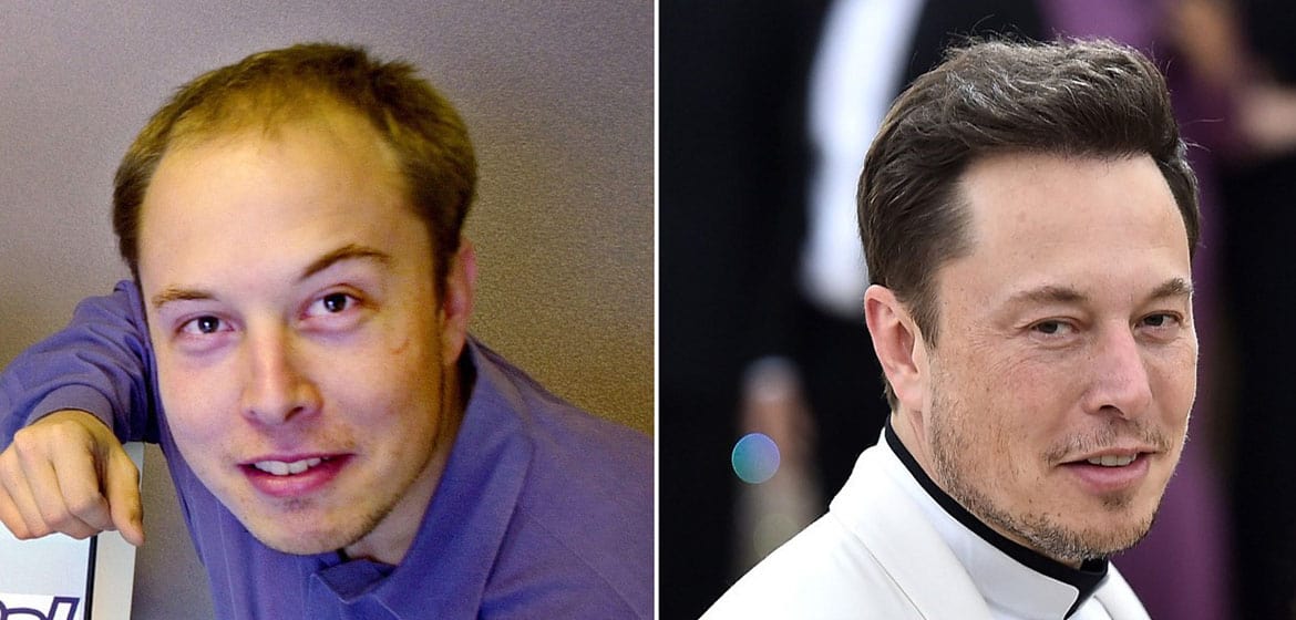 Elon Musk Hair Transplant: From Tech Visionary to Hair Icon 1 Elon Musk Hair Transplant: From Tech Visionary to Hair Icon