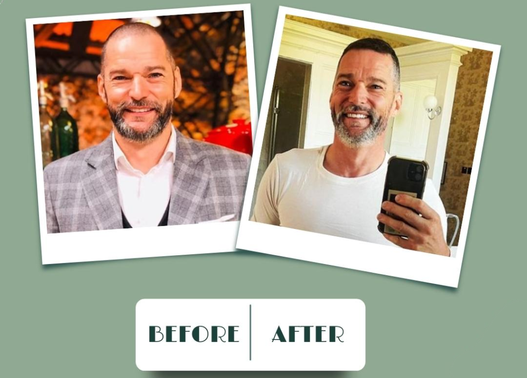 Fred Sirieix Hair Transplant: Rediscovering Confidence and Style 1 Fred Sirieix Hair Transplant: Rediscovering Confidence and Style