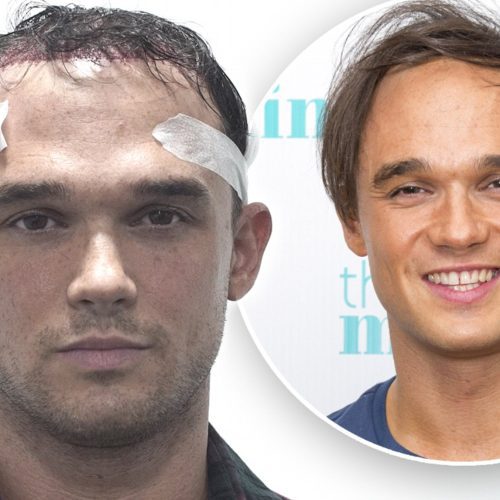 Gareth Gates Hair Transplant: A Journey to Confidence