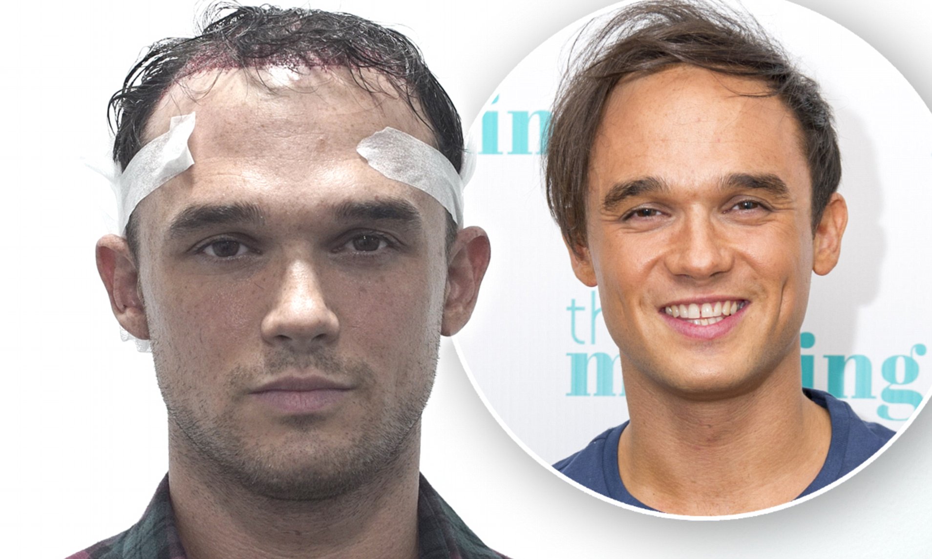 Gareth Gates Hair Transplant: A Journey to Confidence 1 Gareth Gates Hair Transplant: A Journey to Confidence