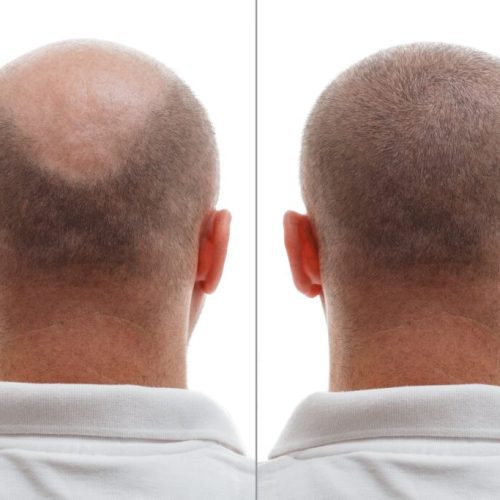 Hair Transplant After 20 Years – Do Hair Transplants Work Long Term?