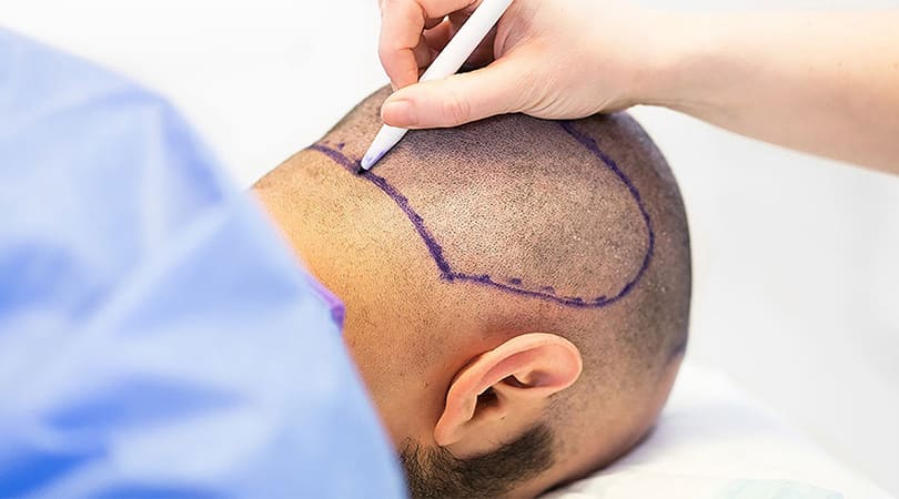 Hair Transplant Recipient Area: What You Need to Know 1 Hair Transplant Recipient Area