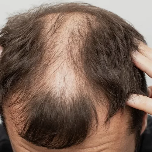 Hair Transplant: With and Without Finasteride – What You Need to Know