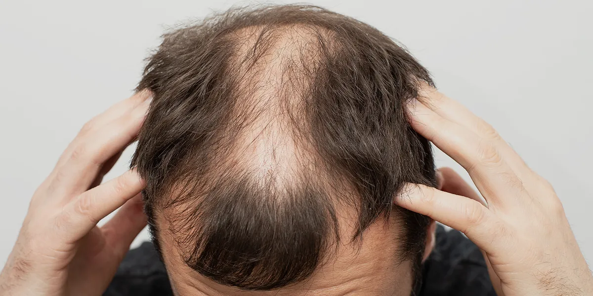 Hair Transplant: With and Without Finasteride – What You Need to Know 1 Hair Transplant: With and Without Finasteride – What You Need to Know
