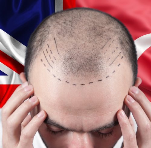 Hair Transplant in the UK vs Turkey: A Comprehensive Comparison