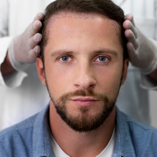 How Long Does a Hair Transplant Last?