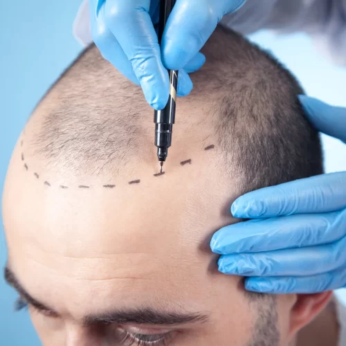 How Much Does a Hair Transplant Cost in Australia?