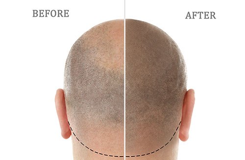 How Much Does a Hair Transplant Cost in India?