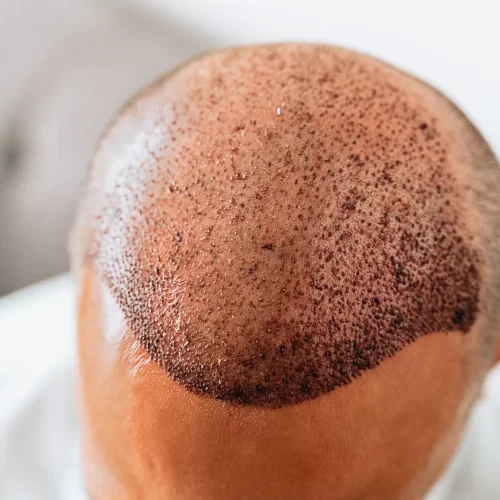 How Much Does A Hair Transplant Cost In Kenya