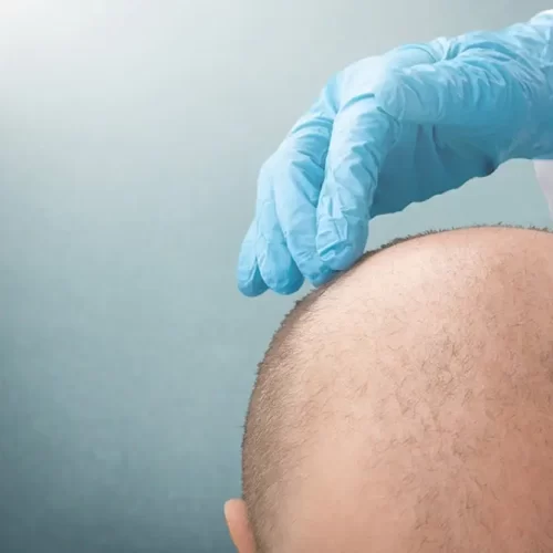 How Much Does A Hair Transplant Cost In Pakistan?