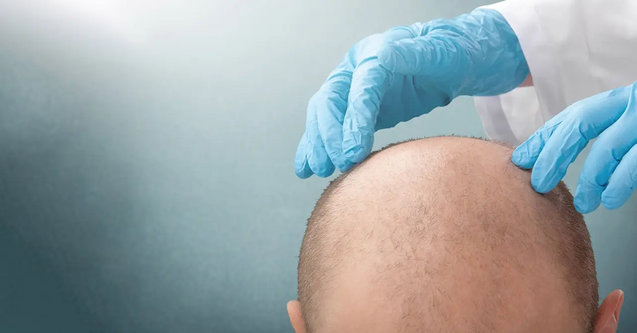 How Much Does a Hair Transplant Cost in Pakistan? 1 How Much Does A Hair Transplant Cost In Pakistan?