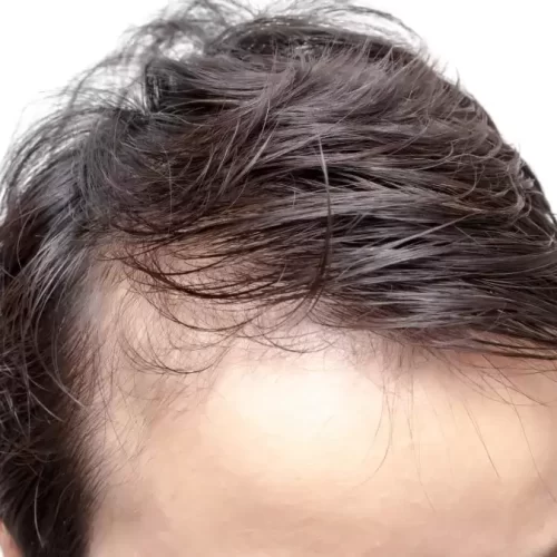 How Much Does A Hair Transplant Cost In The Philippines?