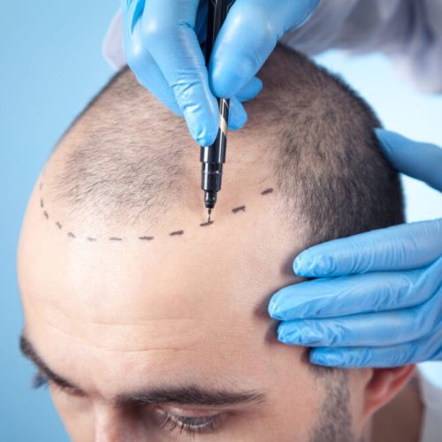 How Much Does a Hair Transplant Cost in Turkey?