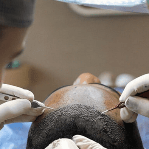 How Much Does a Hair Transplant Cost in the UK?