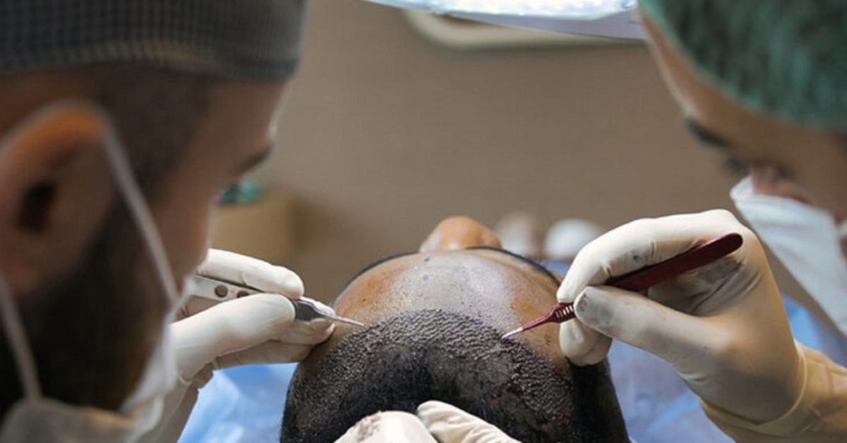 How Much Does a Hair Transplant Cost in the UK? 1 How Much Does a Hair Transplant Cost in the UK?