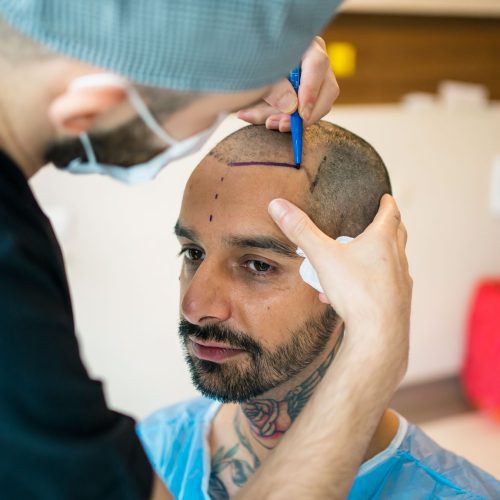 How Much Does a Hair Transplant Cost in the USA?