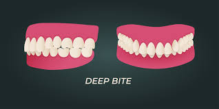 How to Know if You Have a Deep Bite and How to Treat It