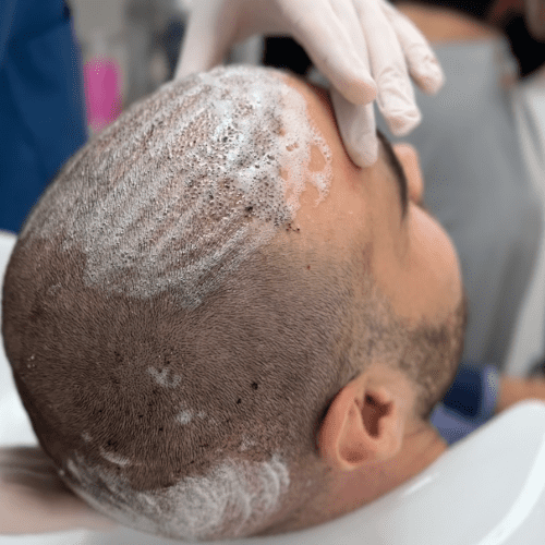 How to Wash Your Hair After a Hair Transplant: A Step-by-Step Guide