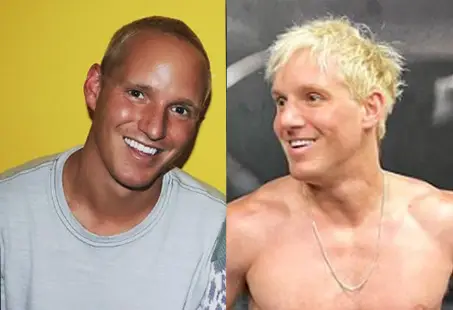 Jamie Laing Hair Transplant