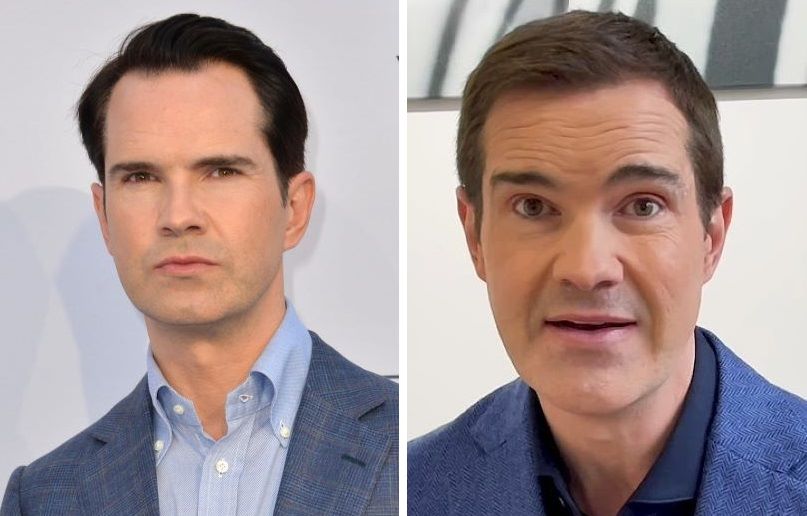 Jimmy Carr Hair Transplant: The Comedian’s Hair Transformation Journey 1 Jimmy Carr Hair Transplant: The Comedian’s Hair Transformation Journey