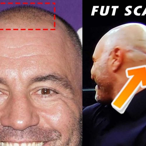 Joe Rogan and Hair Transplants: A Story of Acceptance and Confidence