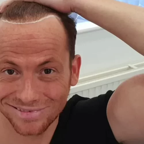 Joe Swash Hair Transplant