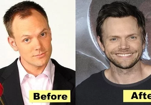 Joel McHale Hair Transplant