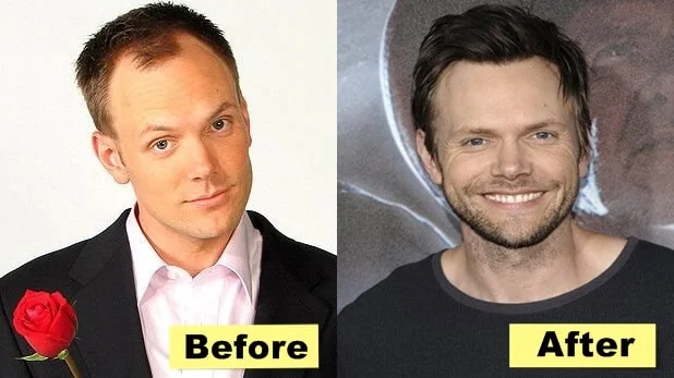 Joel McHale Hair Transplant: The Truth Behind His Hair Transformation 1 Joel McHale Hair Transplant