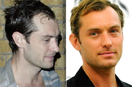 Jude Law Hair Transplant: Did the Hollywood Star Restore His Hairline?