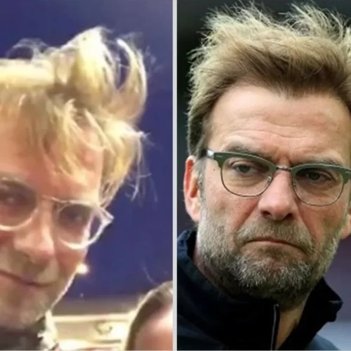 Jürgen Klopp Hair Transplant: How the Football Manager Restored His Hairline