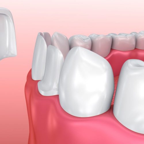 Key Differences Between Teeth Bonding and Veneers Procedure