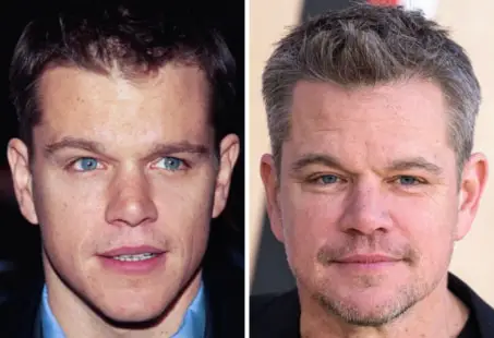 Matt Damon Hair Transplant: Hollywood's Subtle Transformation 1 Matt Damon Hair Transplant: Hollywood's Subtle Transformation