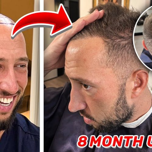 Mike Majlak Hair Transplant Journey