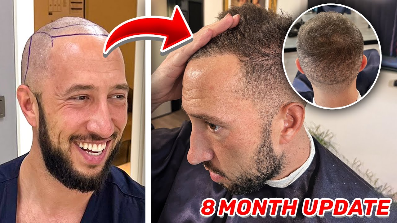 Mike Majlak Hair Transplant Journey: A Story of Confidence and Transparency 1 Mike Majlak Hair Transplant Journey