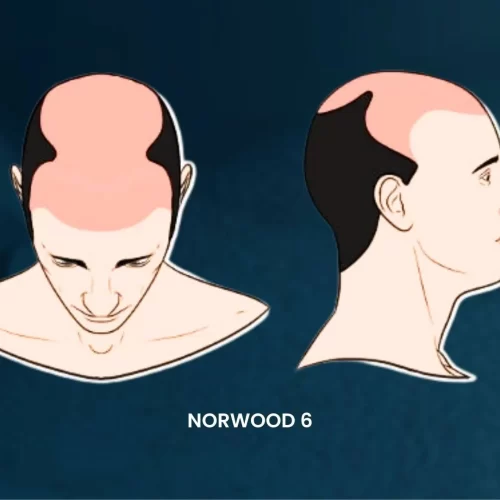 Hair Transplant for Norwood Scale 6: Transforming Advanced Hair Loss