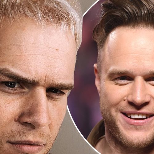 Olly Murs Hair Transplant: A New Chapter of Confidence