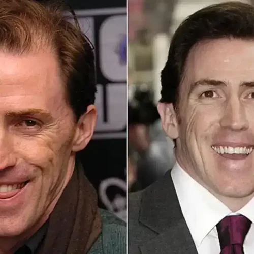 Rob Brydon Hair Transformation: Did the Comedian Have a Hair Transplant?