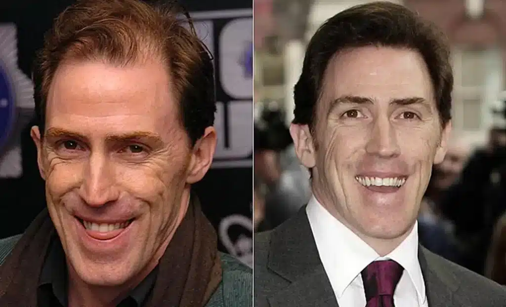 Rob Brydon Hair Transformation: Did the Comedian Have a Hair Transplant? 1 Rob Brydon Hair Transformation: Did the Comedian Have a Hair Transplant?