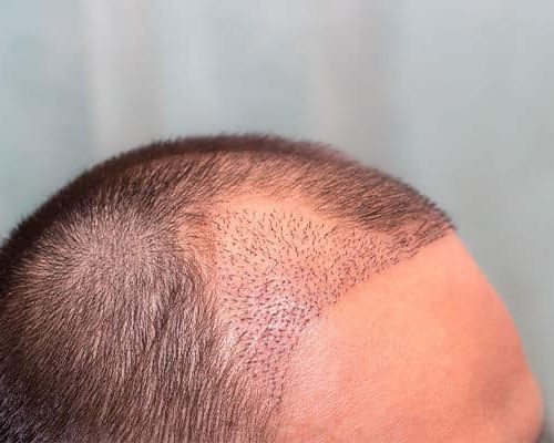 Shock Loss After Hair Transplant: Understanding Temporary Shedding