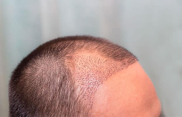 Shock Loss After Hair Transplant: Understanding Temporary Shedding 1 Shock Loss After Hair Transplant: Understanding Temporary Shedding