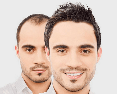 Should I Get a Second Hair Transplant? Key Considerations for a Life-Changing Decision