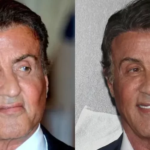 Sylvester Stallone and Hair Transplants: Did He Undergo a Hair Restoration Procedure?