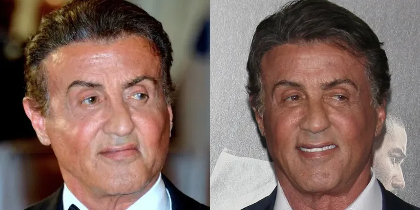 Sylvester Stallone and Hair Transplants: Did He Undergo a Hair Restoration Procedure? 1 Sylvester Stallone and Hair Transplants: Did He Undergo a Hair Restoration Procedure?