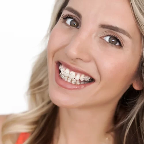 Teeth Shifting: Key Signs You Should Never Ignore