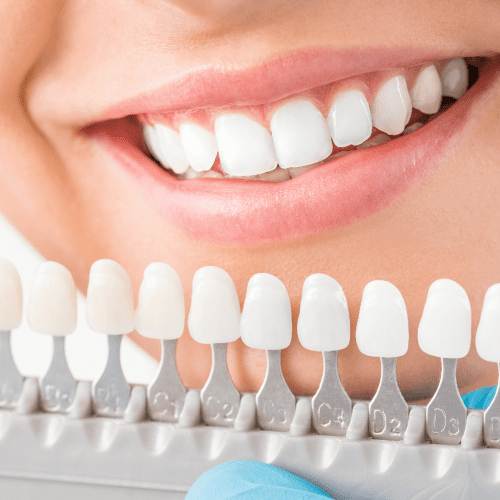 Teeth Whitening Treatments for Sensitive Teeth: A Comprehensive Guide