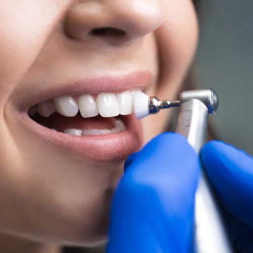 Teeth Whitening vs. Teeth Cleaning: What’s the Difference for a Whiter, Brighter Smile?