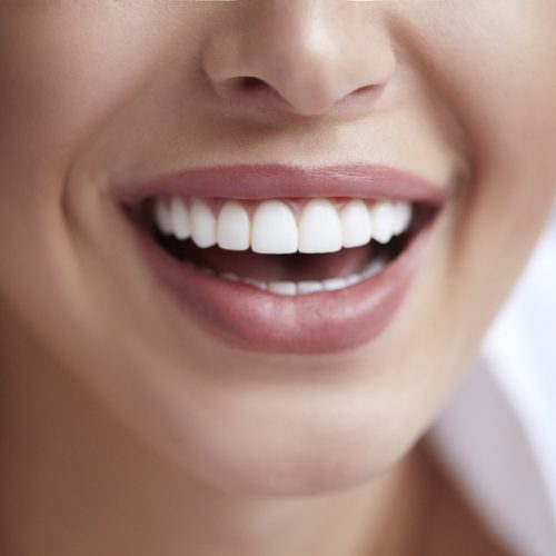 The Cost of Veneers in Turkey: A Comprehensive Overview