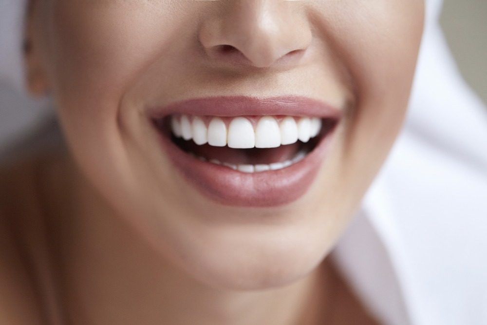 The Cost Of Veneers In Turkey A Comprehensive Overview