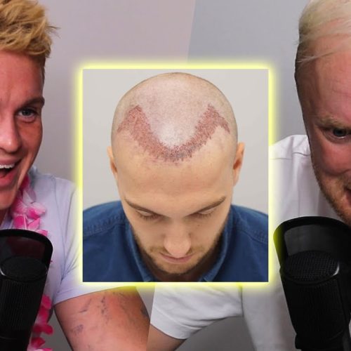 Theo Baker Hair Transplant: A Journey to Confidence